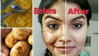 Remove dark spots in just 7 days  100 Natural  Get rid of uneven skintone [upl. by Suirauqed]