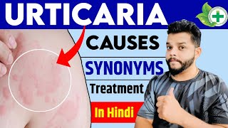 Urticaria Causes Symptoms Treatment In Hindi  Allergy In Hindi [upl. by Aneeuq]