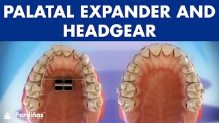 Orthodontic devices  Palatal expander and headgear © [upl. by Jonna]