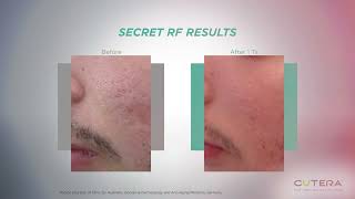 RF Microneedling amp Technology at Kingsway Dermatology amp Cosmetic Centre  Toronto ON [upl. by Notniw]