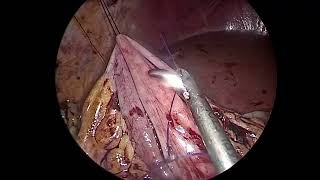 Intracorporeal Anastomosis Laparoscopic complete mesocolic excision right colon Cancer Ali Zedan [upl. by Yenar7]