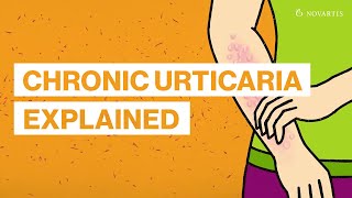 What is chronic urticaria [upl. by Duma678]