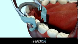 Présentation technique du Palodent Plus  Dentsply [upl. by Marl]