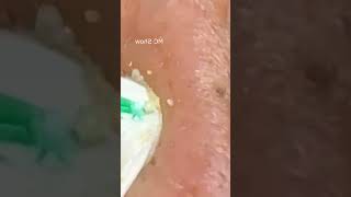 Pickel Ausdrücken Blackheads Akne amp Mitesser entfernen 🔴 24 [upl. by Mariska466]