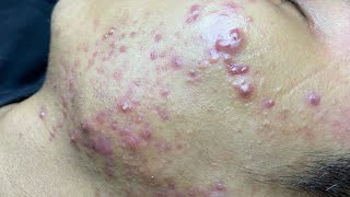 ACNE TREATMENT VU QUYNH MI  Blackheads Of Tweens 2024 EX [upl. by Snah948]