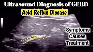 Ultrasound Gastroesophageal Junction Gerd  Acid Reflux Disease [upl. by Amoakuh]