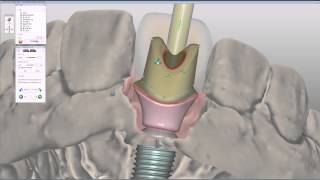 Customized zirconia abutment on titanium base CAD Design [upl. by Sassan]