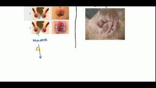 Hemorrhoids Lecture for USMLE [upl. by Anih]