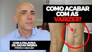 COMO ACABAR COM AS VARIZES Eu sou médico vascular você sabia  Dr Dayan Siebra varizes saude [upl. by Flodur]