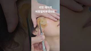 리팟 레이저 다발성 흑자 세종리팟 세종시리팟 reepot lentigo multiplelentigo 청주리팟 공주리팟 대전리팟 오창리팟 오송리팟 부여리팟 [upl. by Annauj574]