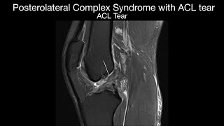 Posterolateral Corner Syndrome with ACL Tear [upl. by Wahl347]