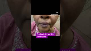 Lip stick Dermatitis  lip eczema  lipcare  Dermatologist in Punjab  Dr Ashima Goel [upl. by Ammon349]