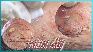 Big Cystic Acne Blackheads Extraction Blackheads amp Milia Whiteheads Removal Pimple Popping [upl. by Toiboid]