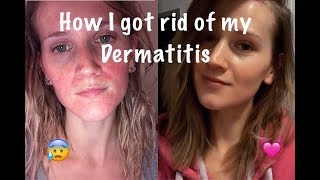 How I Cured My Perioral Dermatitis [upl. by Silbahc795]