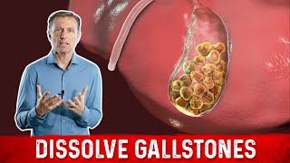 What Causes Gallstones amp How to Treat Them – DrBerg [upl. by Melany]