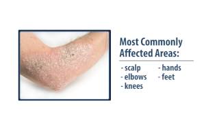 Common Skin Disorders Eczema amp Psoriasis [upl. by Coco]