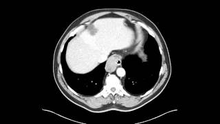 Esophageal leiomyoma of distal esophagus Chest CT [upl. by Annahsat894]