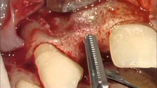 CAMLOG Implant Placement  Part 1  Surgery [upl. by Eiramalegna596]