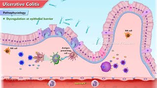 Ulcerative Colitis Animation  Etiology Clinical features Pathophysiology Diagnosis Treatment [upl. by Oam]