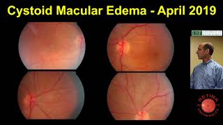 Cystoid Macular Edema [upl. by Santa970]