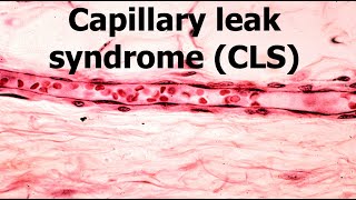 Capillary leak Syndrome [upl. by Boni]