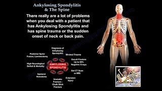 Ankylosing Spondylitis amp The Spine  Everything You Need To Know  Dr Nabil Ebraheim [upl. by Brown]