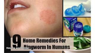 home remedies for ringworm [upl. by Zerlina]