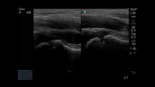 PointofCare Ultrasound for Hip Effusion [upl. by Sualocin]