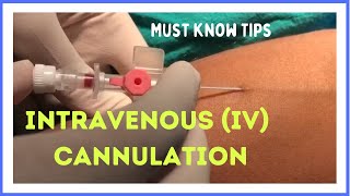 INTRAVENOUS IV CANNULATION in 5 mins How to insert [upl. by Fatima591]