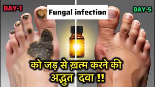 Fungal infection homeopathic treatmenthomeopathic medicine [upl. by Gamal728]