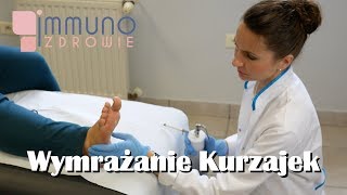 Wymrażanie Kurzajek Ciekłym Azotem Kriochirurgia [upl. by Iloj]