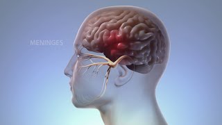 What Happens In Your Body During Migraine  WebMD [upl. by Remliw]