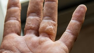 Dyshidrotic Eczema What Is Dyshidrotic Eczema [upl. by Terena]