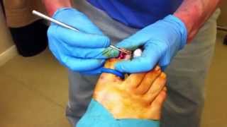 Chiropodist and Podiatrist in Norwich  Nail Surgery [upl. by Galligan506]