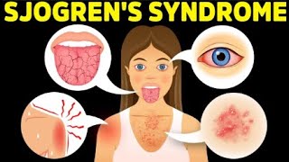 Sjögrens Syndrome The Hidden Cause of Dry Eyes and Mouth [upl. by Zoilla]