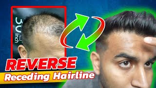 How To StopReverse a Receding Hairline [upl. by Ened999]