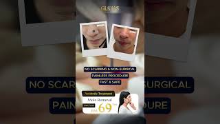 AESTHETIC CLINIC MALAYSIA  Laser Mole Removal See the Difference [upl. by Teplitz611]