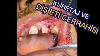 Diş taşı temizliği sonrası küretaj ve diş eti ameliyatıGum surgery and curettageteeth cleaning [upl. by Melac]