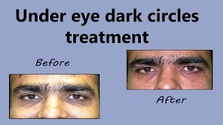 Under Eye Dark Circles Treatment  Laser Pigmentation Removal  Dr Rinky Kapoor [upl. by Benjie]