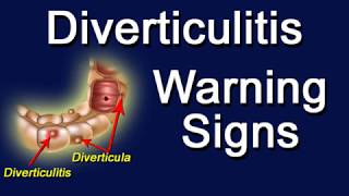 Diverticulitis Warning Signs [upl. by Carr]