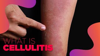 What is Cellulitis  Symptoms and Treatment Options [upl. by Haerr]