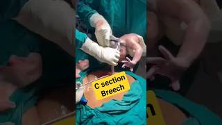 c sectionbreech deliverybaby birthshortsvideo [upl. by Laval]