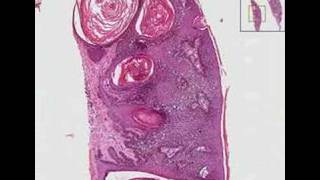 Histopathology Skin Seborrheic keratosis [upl. by Reade807]