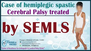 Hemiplegic Spastic CPwmv [upl. by Rabka399]