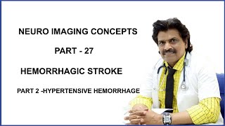 NEURO IMAGING CONCEPTS PART 27 HEMORRHAGIC STROKE PART 2  HYPERTENSIVE HEMORRHAGE [upl. by Aneliram]