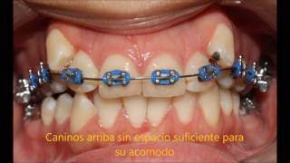 CASO ORTODONCIA MINIIMPLANTES DISTALIZACION MOLARES [upl. by Heinrike364]