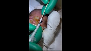 Retinopathy of Prematurity ROP Intravitreal Lucentis NICU [upl. by Mansoor116]