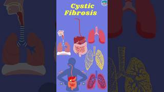 Cystic Fibrosis Mechanism Development Management and Treatment cysticfibrosis cystic [upl. by Ozkum]