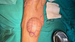 Multiple Lipoma Treatment experience Dr Ashish Bhanot [upl. by Lahcsap]