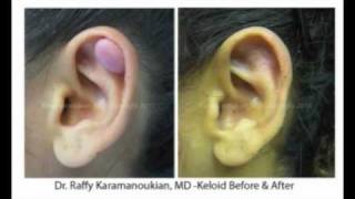 Keloid Surgery in Los Angeles  Dr Karamanoukian Santa Monica Plastic Surgery [upl. by Eltsyrc]